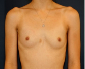 Feel Beautiful - Breast Augmentation 139 - Before Photo